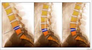 degenerative disc disease cincinnati chiropractor spine back pain neck pain